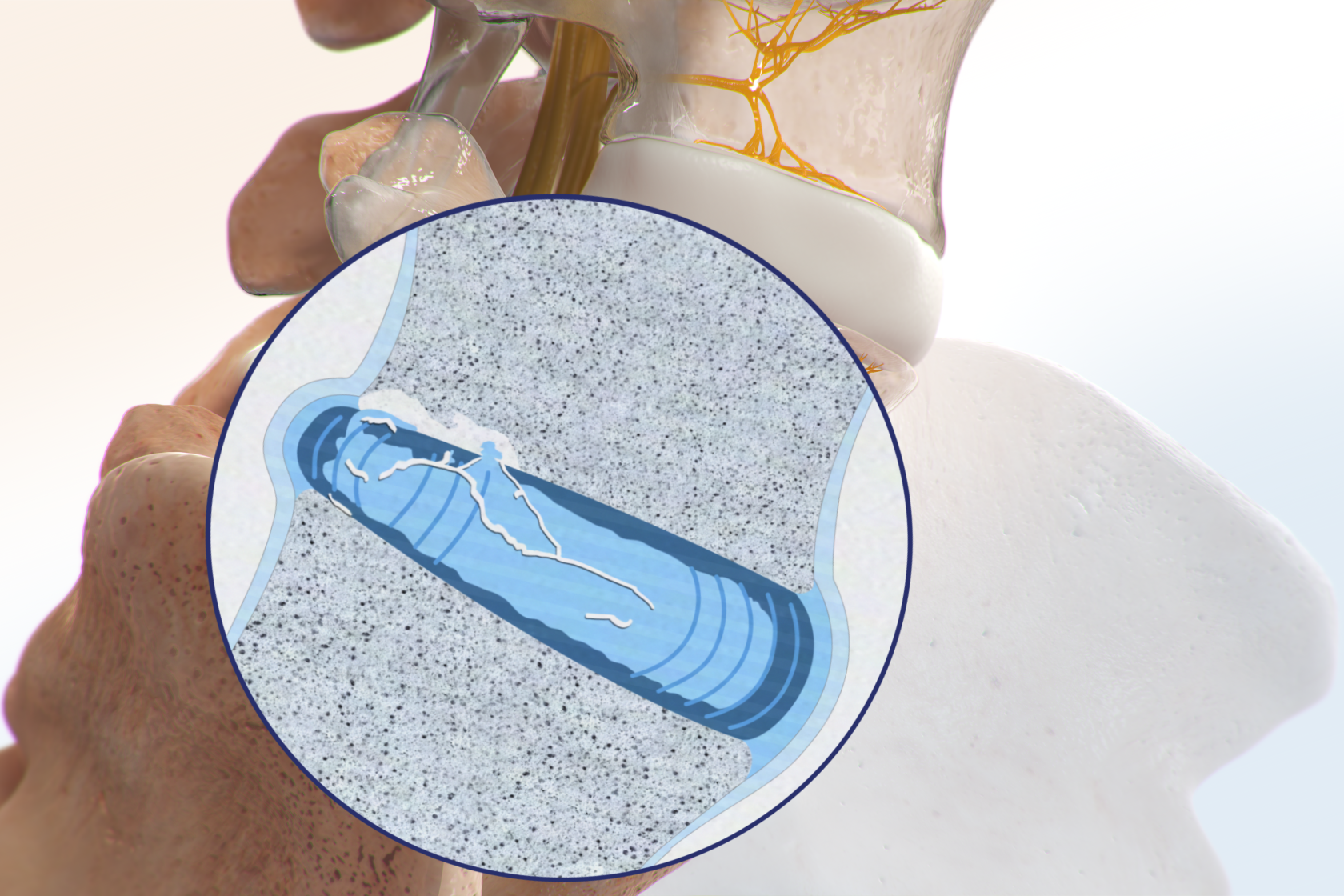 An inflamed disc with endplate damage.