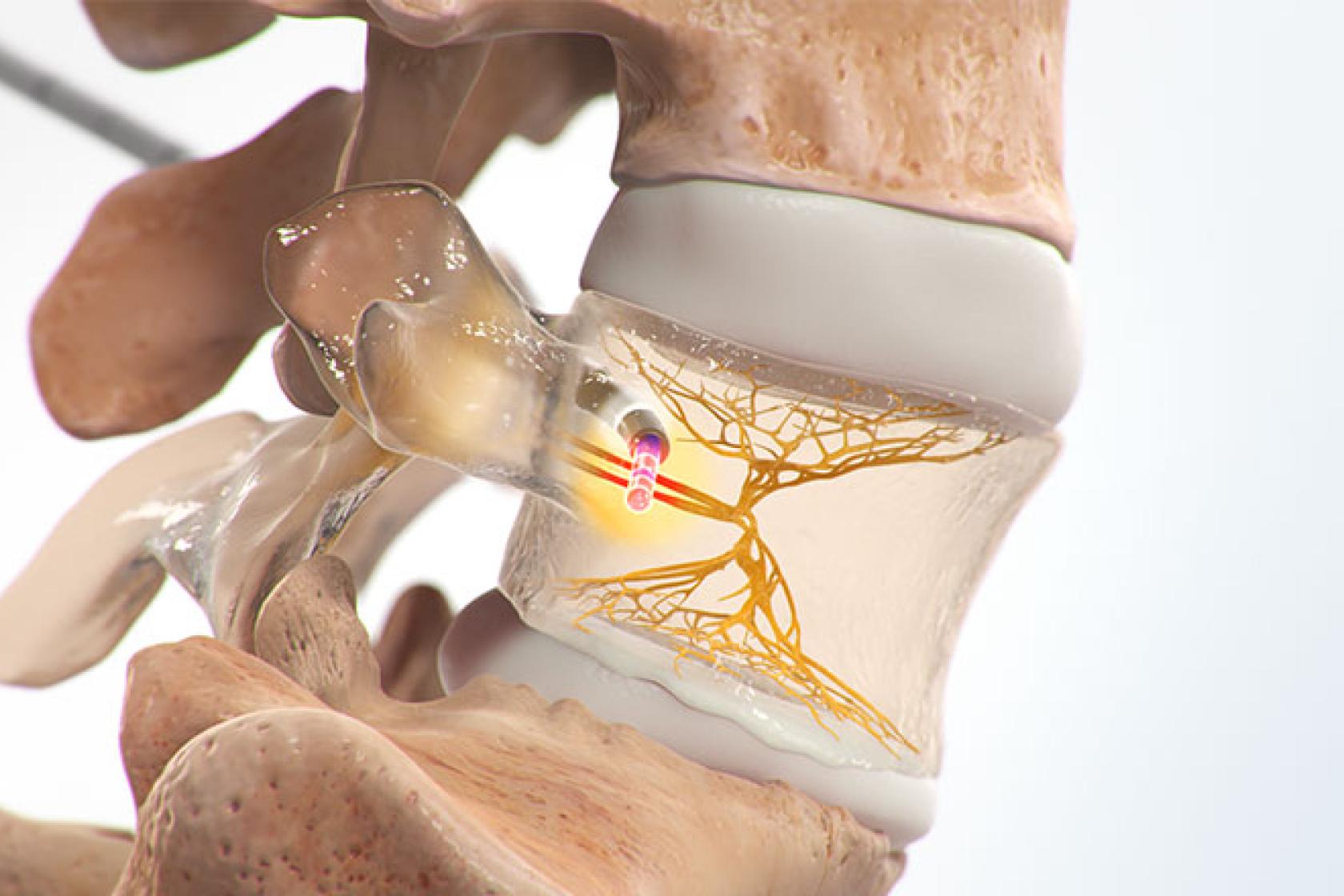 Treatment to the basivertebral nerve.